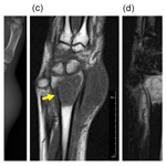 JBJI - Salmonella osteomyelitis of the distal radius in a healthy ...